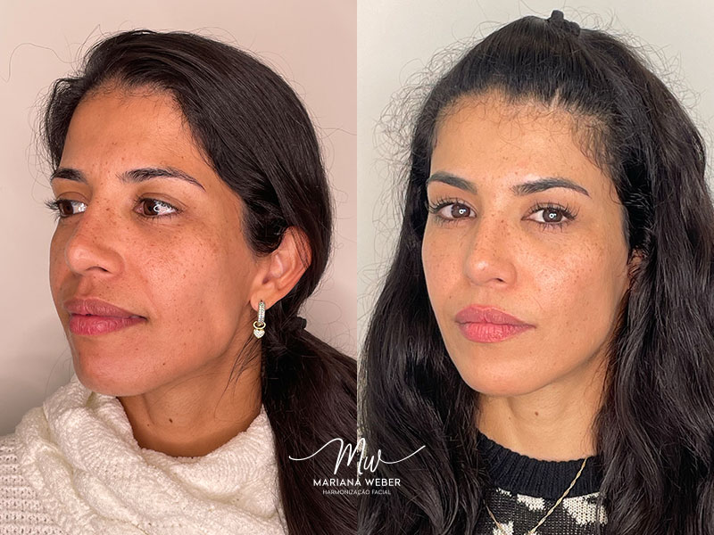 Resultado 3 - Melhora na textura da pele